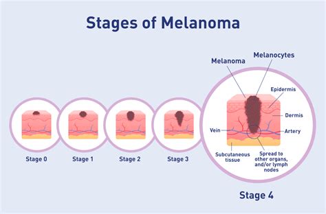 melanoma 4 stadio